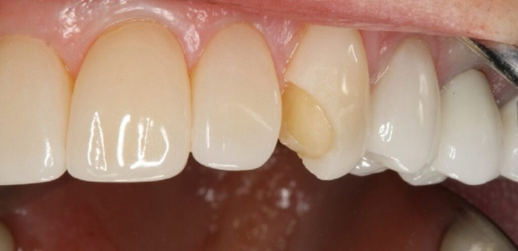 افتادن لمینت دندان