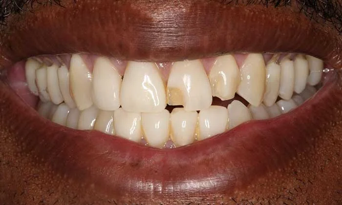 افتادن لمینت دندان