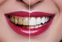 علت تغییر رنگ لمینت دندان چیست؟