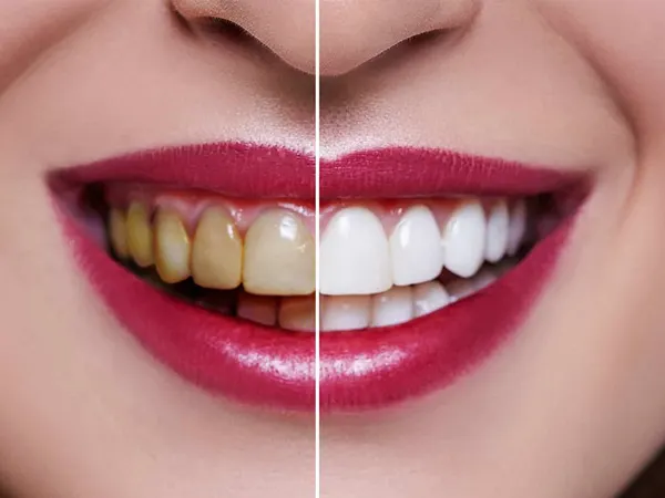 علت تغییر رنگ لمینت دندان چیست؟