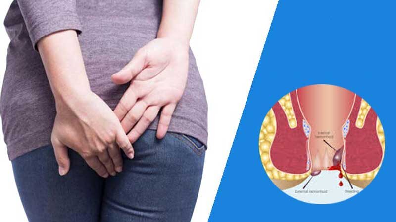 بیماری هموروئید