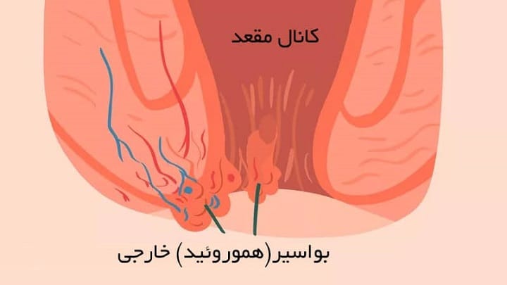 بیماری هموروئید