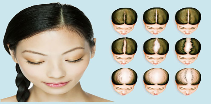 مکمل ها و محصولات تخصصی برای درمان ریزش مو