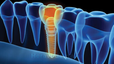 ایمپلنت فوری دندان چیست + مراحل + مزایا و معایب