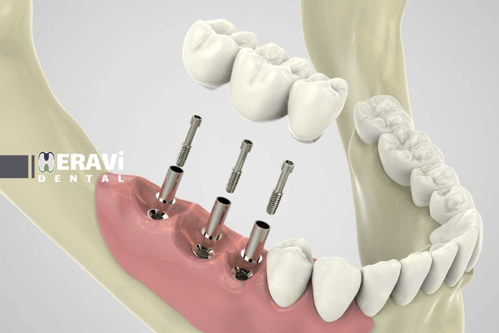 مقایسه ایمپلنت دیجیتال و سنتی: تکنیک، هزینه و نتیجه درمان 3 ایمپلنت دیجیتال یا سنتی؟