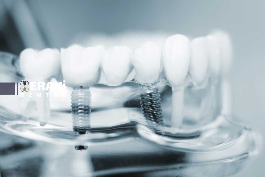 ایمپلنت دندان دیجیتال