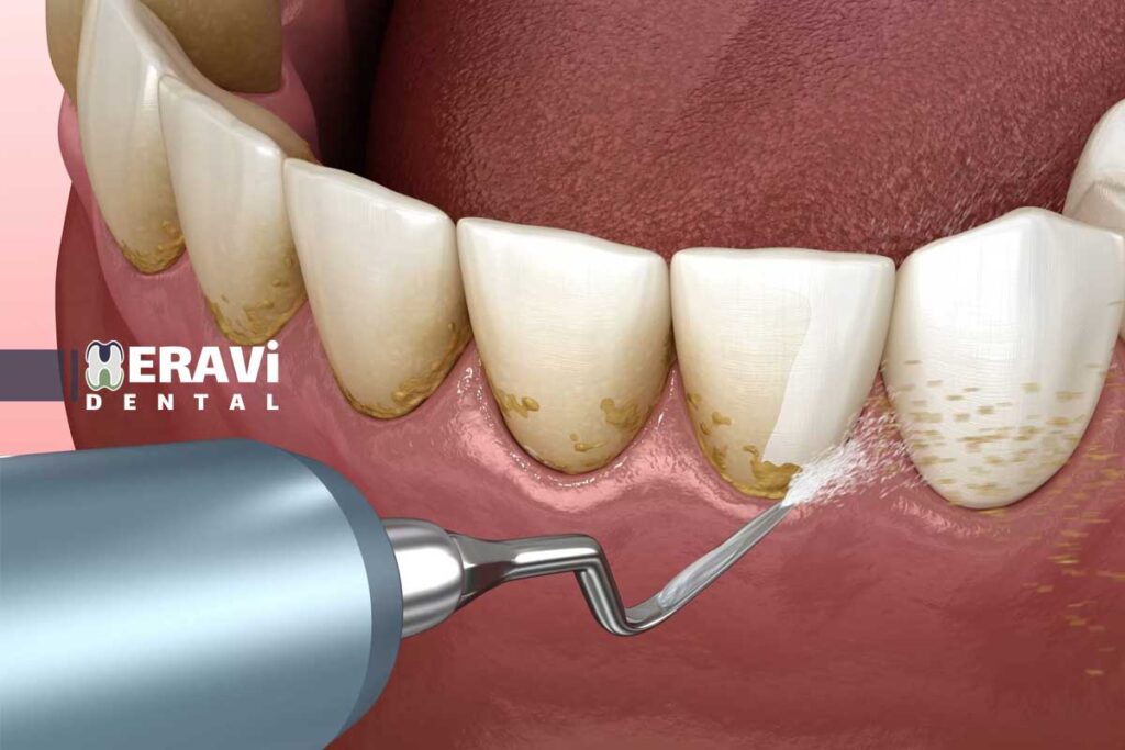 آیا جرمگیری دندان مینای دندان را از بین میبرد یا باعث نازک شدن آن میشود؟ 4 آیا جرمگیری دندان مینای دندان را از بین میبرد یا باعث نازک شدن آن میشود؟