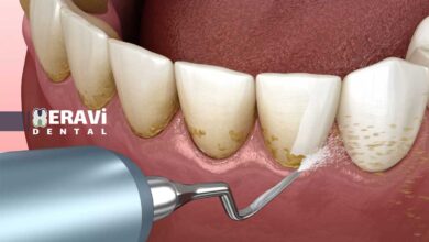 آیا جرمگیری دندان مینای دندان را از بین میبرد یا باعث نازک شدن آن میشود؟