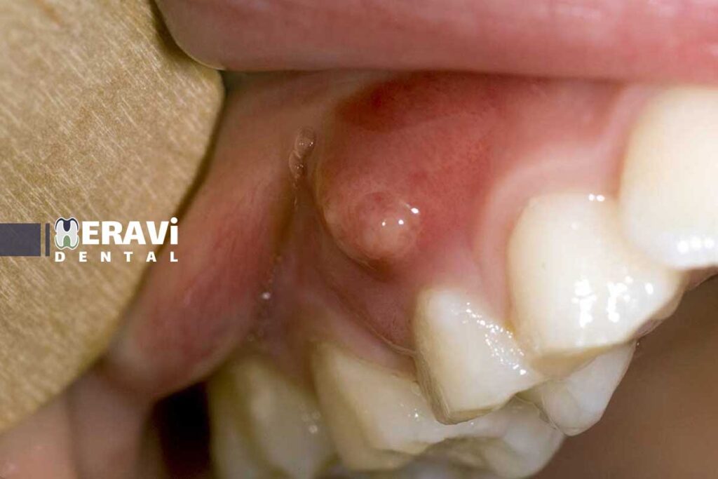 روش‌های نوین جراحی و لیزری کیست و توده لثه