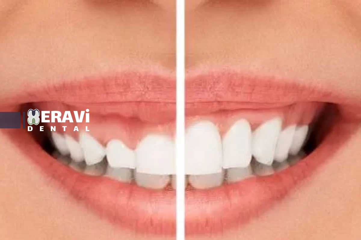 جراحی لثه: از درمان بیماری تا زیبایی لبخند + معرفی روش‌های لیزری و سنتی