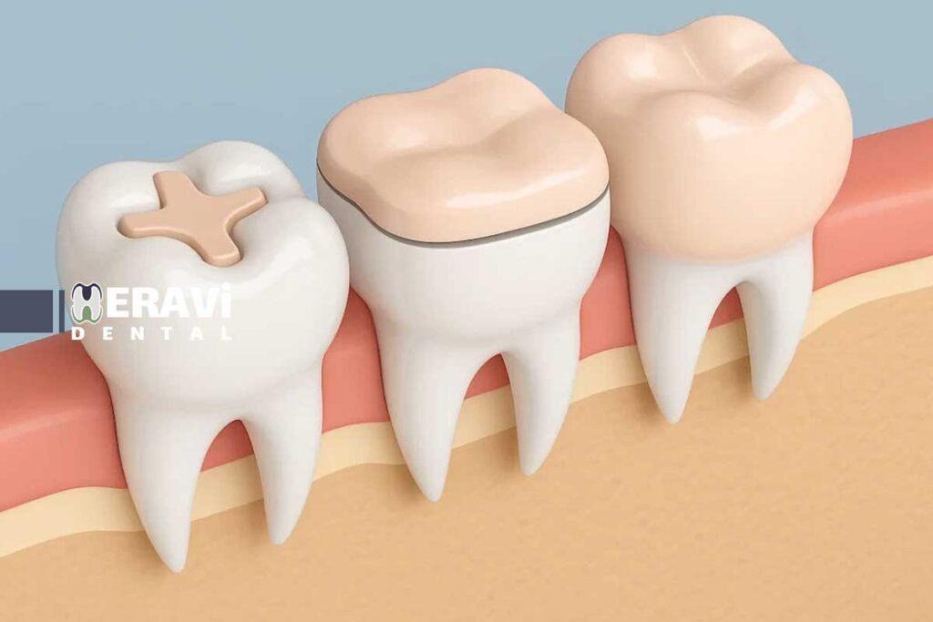 روش های نوین ترمیم پوسیدگی: لیزر، اینله و انله