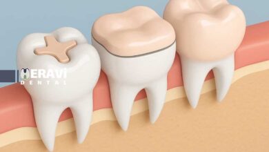 روش های نوین ترمیم پوسیدگی: لیزر، اینله و انله