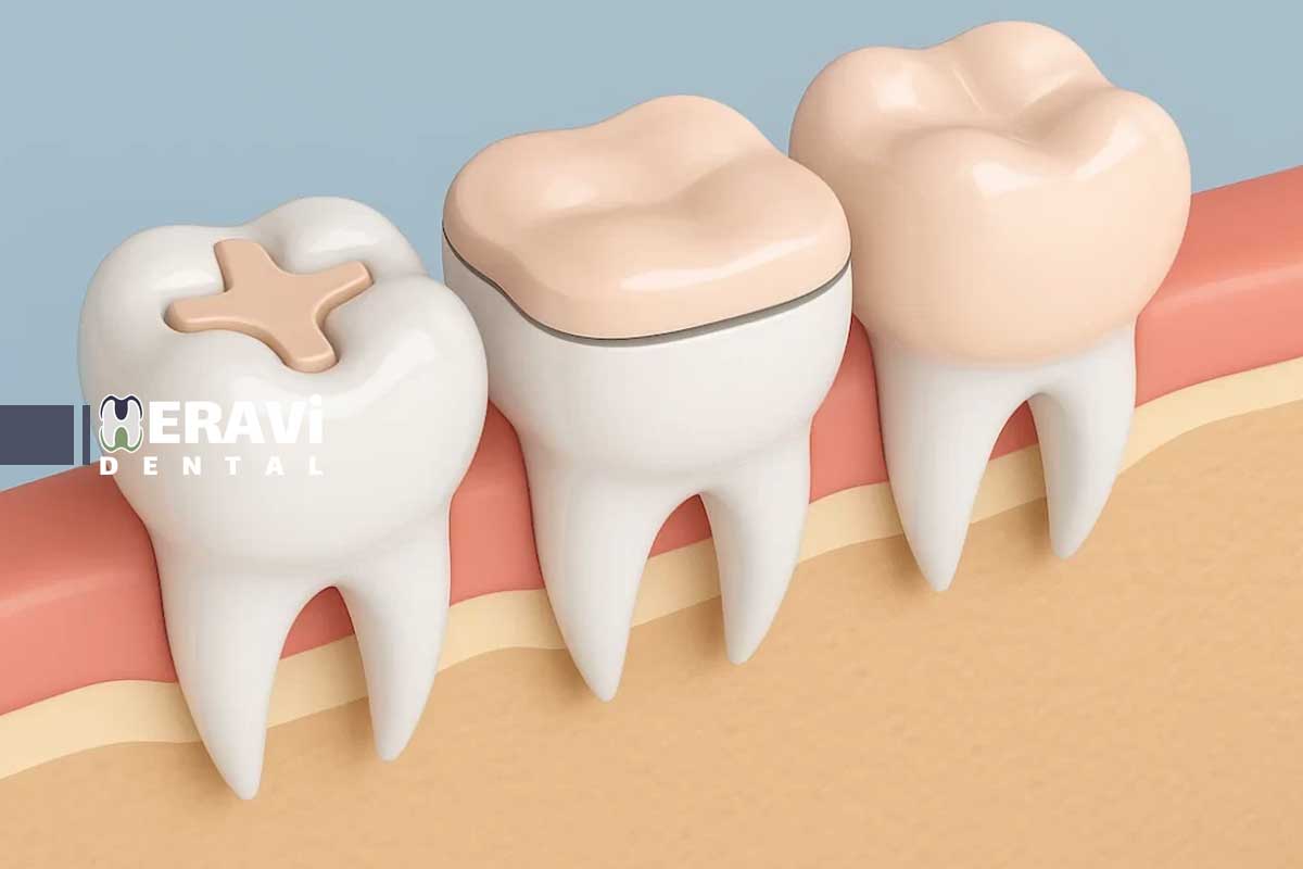 روش های نوین ترمیم پوسیدگی: لیزر، اینله و انله