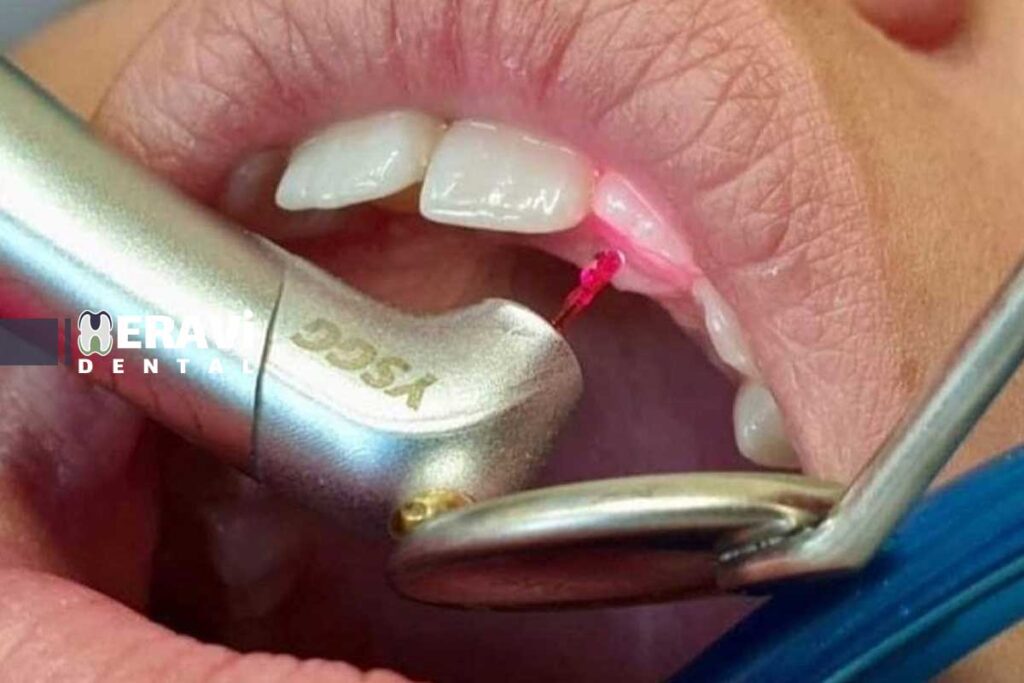 استفاده از لیزر در درمان پوسیدگی