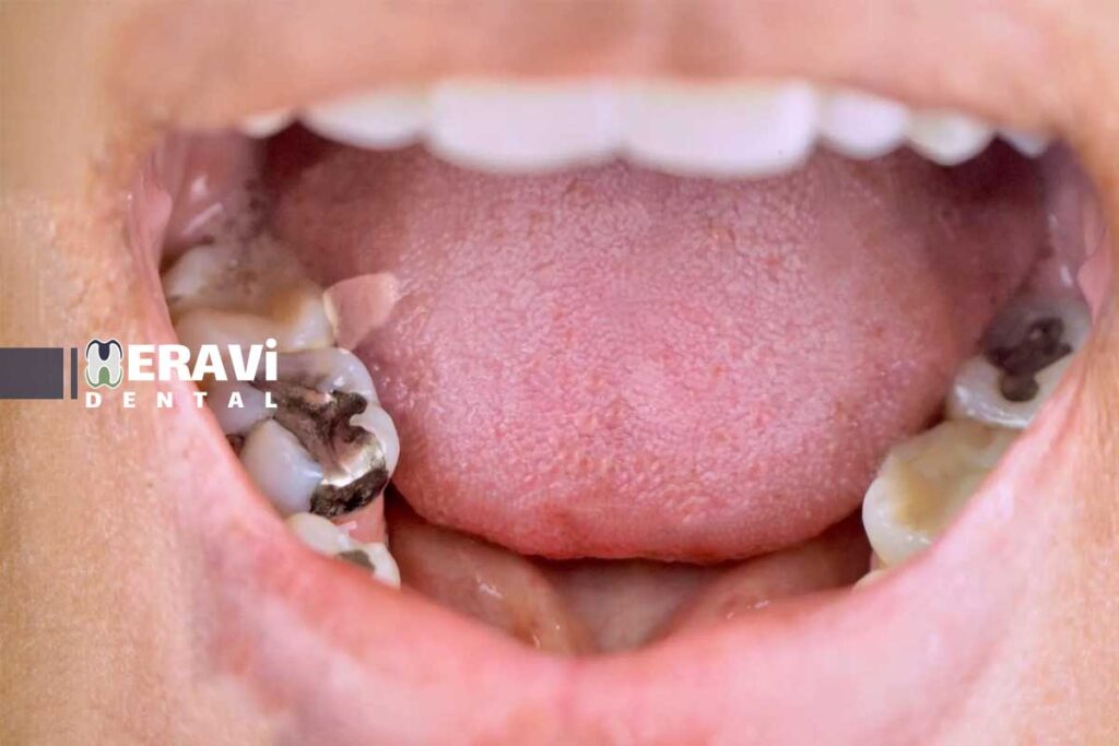 درمان پوسیدگی دندان: علائم، مراحل و روش های ترمیم