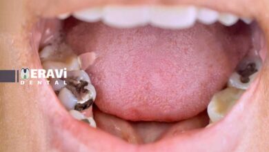 درمان پوسیدگی دندان: علائم، مراحل و روش های ترمیم