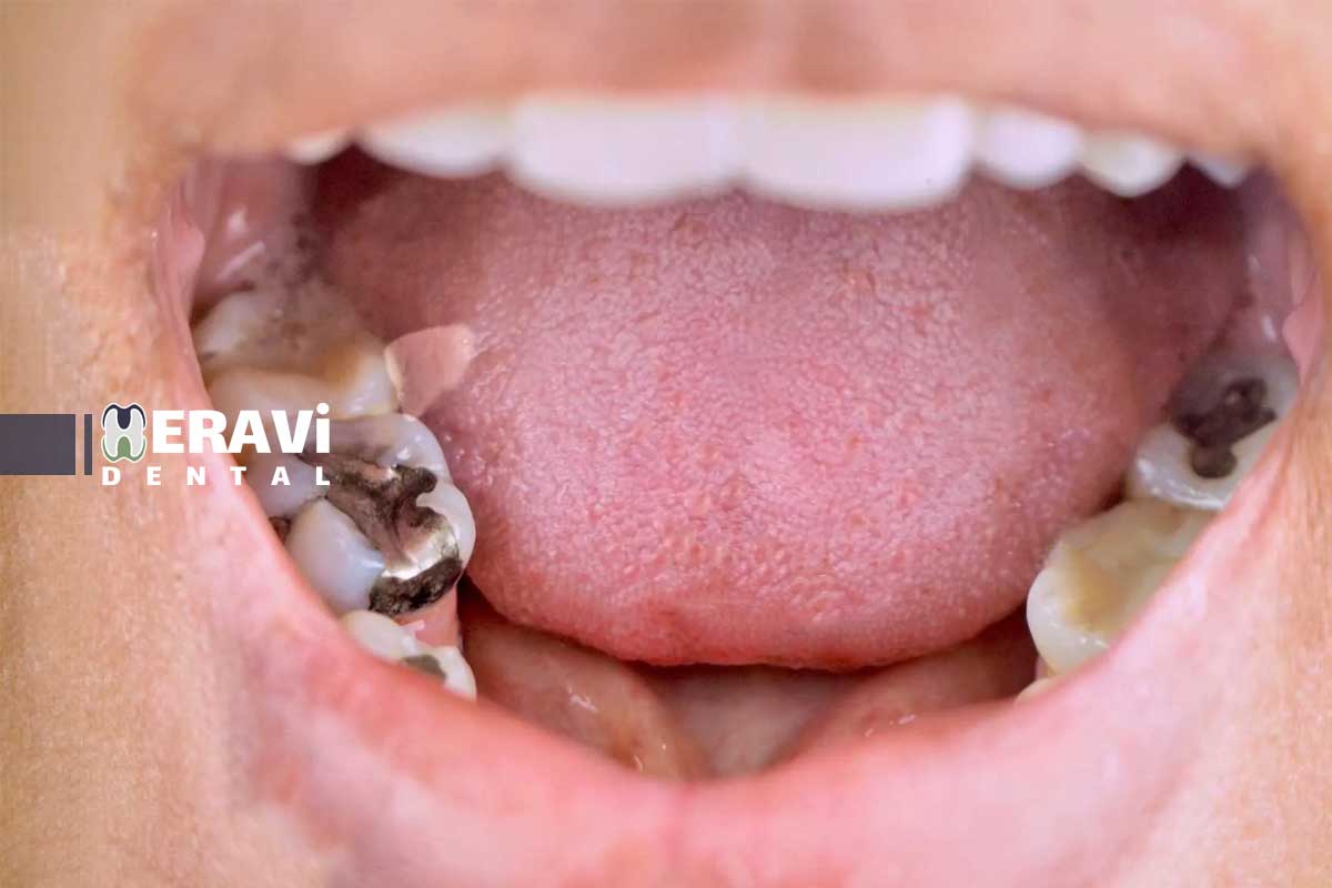 درمان پوسیدگی دندان: علائم، مراحل و روش های ترمیم