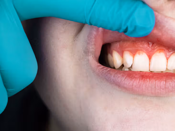 درمان تحلیل لثه و حساسیت ریشه: جراحی پوشاندن ریشه و پیوند بافت نرم