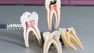 جراحی پیشرفته ریشه دندان با میکروسکوپ و مواد نوین اندو