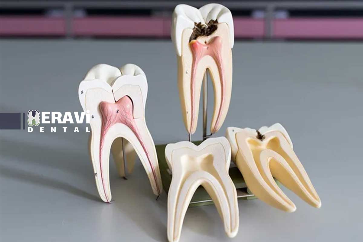 جراحی پیشرفته ریشه دندان با میکروسکوپ و مواد نوین اندو