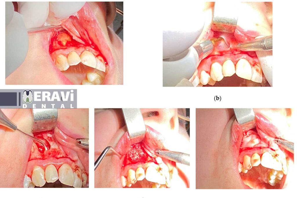 جراحی پیشرفته ریشه دندان