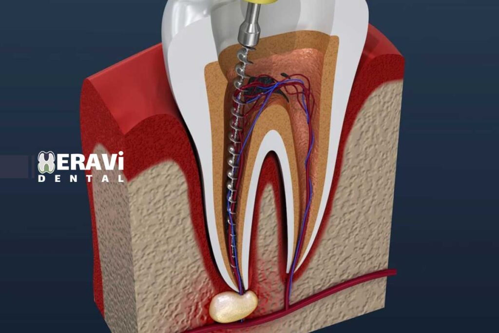 جراحی پیشرفته ریشه دندان چیست