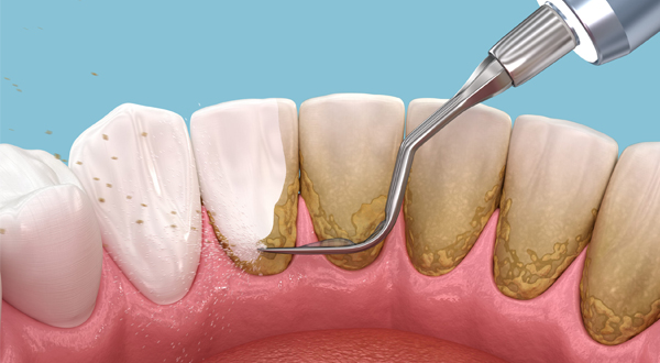 جرمگیری دندان چیست و چگونه انجام می‌شود؟