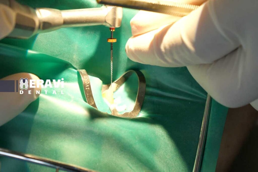 عصب‌کشی و جراحی ریشه