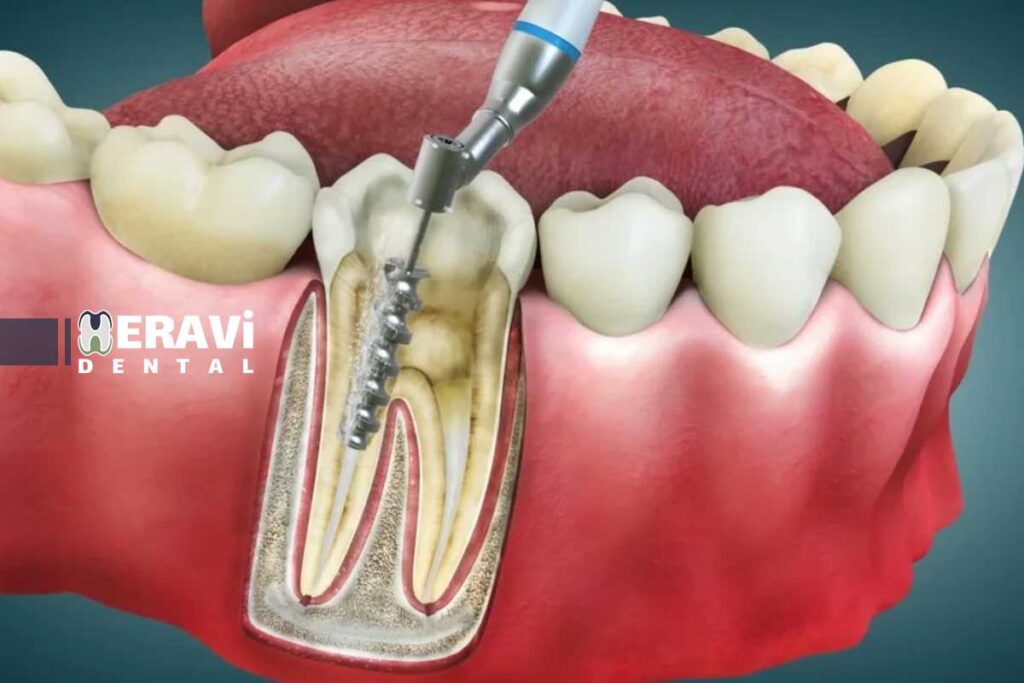 تجهیزات تخصصی عصبکشی و جراحی ریشه: راهنمای انتخاب و استفاده 8 تجهیزات تخصصی عصبکشی و جراحی ریشه: راهنمای انتخاب و استفاده