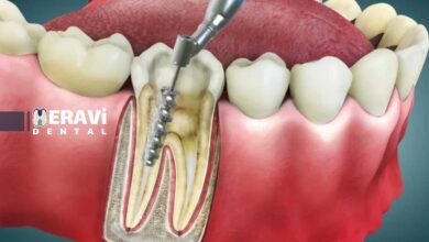 تجهیزات تخصصی عصبکشی و جراحی ریشه: راهنمای انتخاب و استفاده