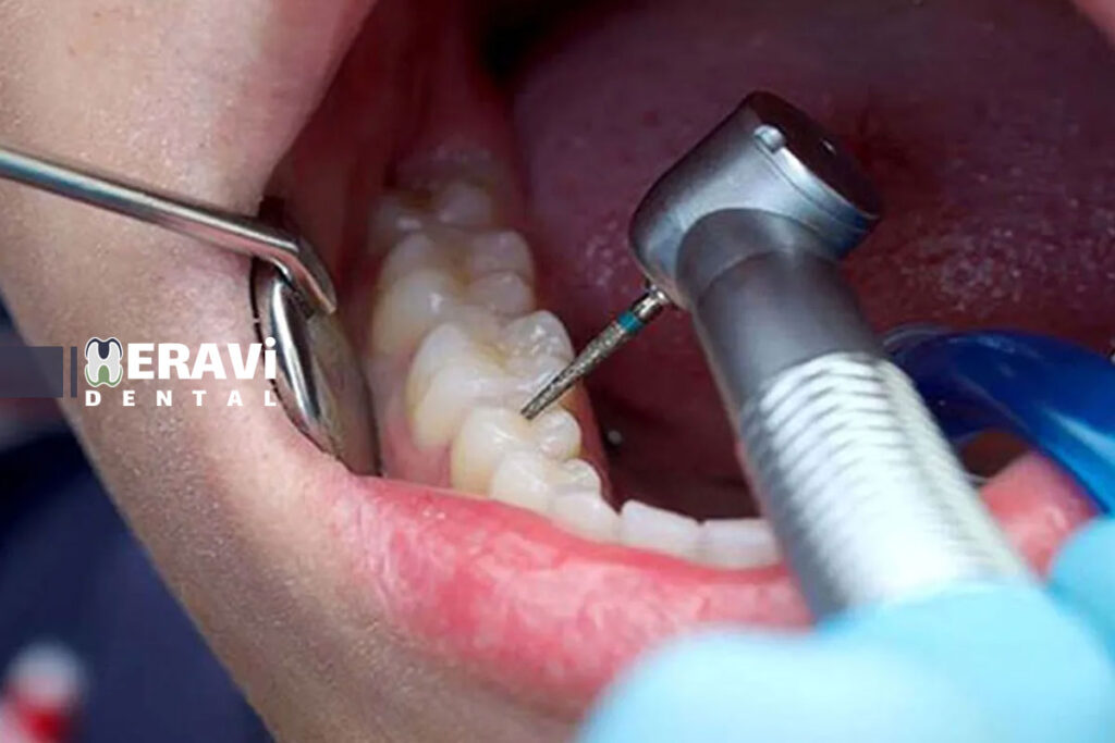 عوارض عصب کشی دندان 5