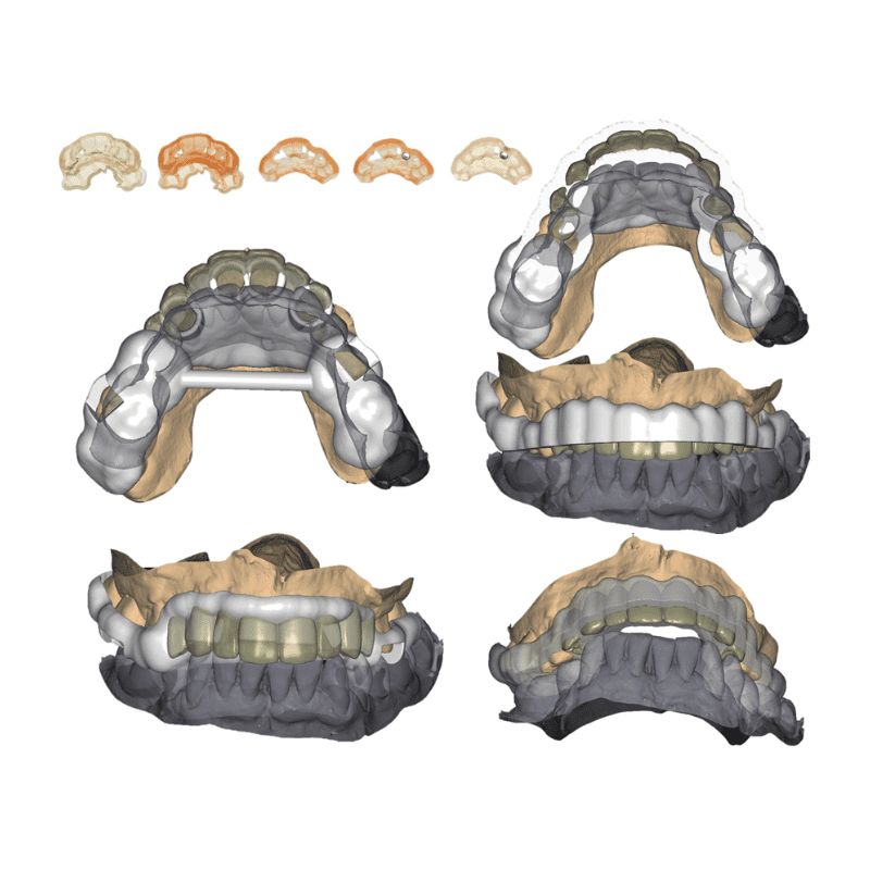 ایمپلنت دیجیتال