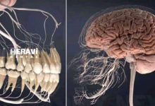 ارتباط سلامت دهان و خطر سکته مغزی؛ بررسی علمی جدید در سال 2025