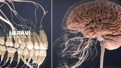 ارتباط سلامت دهان و خطر سکته مغزی؛ بررسی علمی جدید در سال 2025
