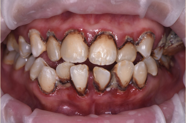 دیابت و تاثیر آن بر دندان