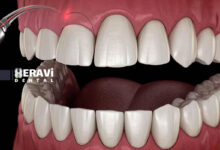 تاثیر فشار خون بالا بر جراحی فک و لثه چیست و چگونه خطرات آن را قبل از عمل کاهش دهیم؟