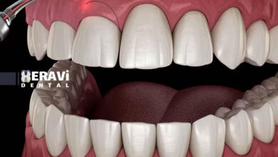 تاثیر فشار خون بالا بر جراحی فک و لثه چیست و چگونه خطرات آن را قبل از عمل کاهش دهیم؟