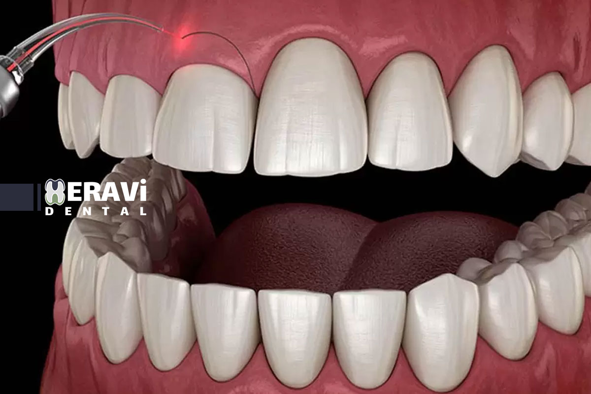 تاثیر فشار خون بالا بر جراحی فک و لثه چیست و چگونه خطرات آن را قبل از عمل کاهش دهیم؟