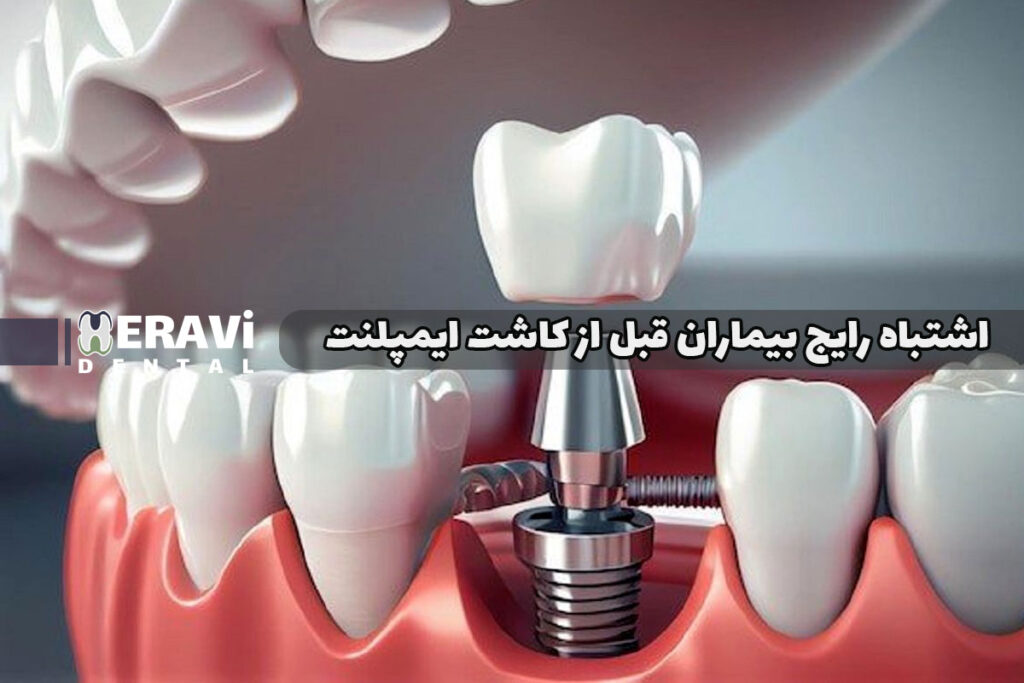 ۷ اشتباه رایج بیماران قبل از کاشت ایمپلنت