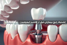 ۷ اشتباه رایج بیماران قبل از کاشت ایمپلنت