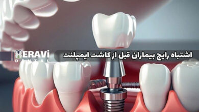 ۷ اشتباه رایج بیماران قبل از کاشت ایمپلنت