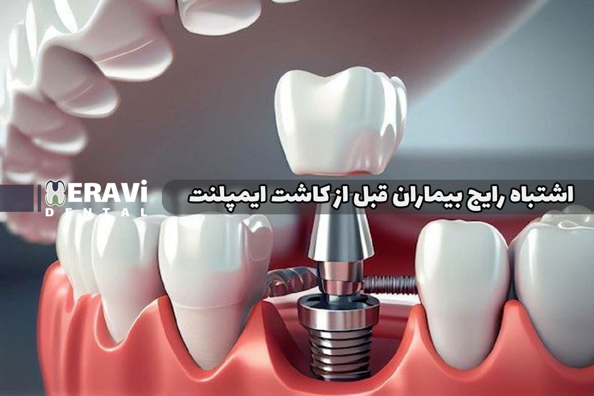 ۷ اشتباه رایج بیماران قبل از کاشت ایمپلنت