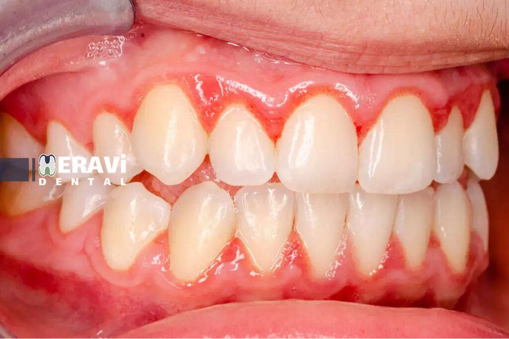 The role of anti inflammatory