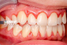 The role of anti inflammatory