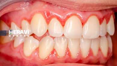 The role of anti inflammatory