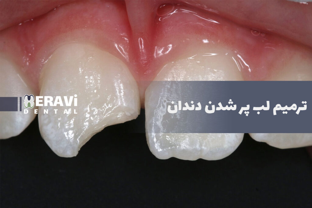 درمان لب پر شدن دندان جلو با روش های سریع و ماندگار برای بازگرداندن لبخند طبیعی