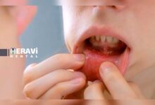 غربالگری سرطان دهان در افراد سیگاری چرا تشخیص زودهنگام جان شما را نجات می دهد؟