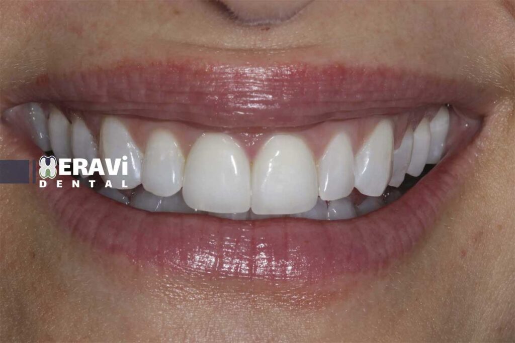 راهکارهای داشتن کامپوزیت دندان طبیعی و زیبا