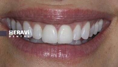 راهکارهای داشتن کامپوزیت دندان طبیعی و زیبا