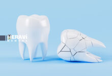 دندان شکسته و خطر عفونت: چرا اقدام فوری حیاتی است؟
